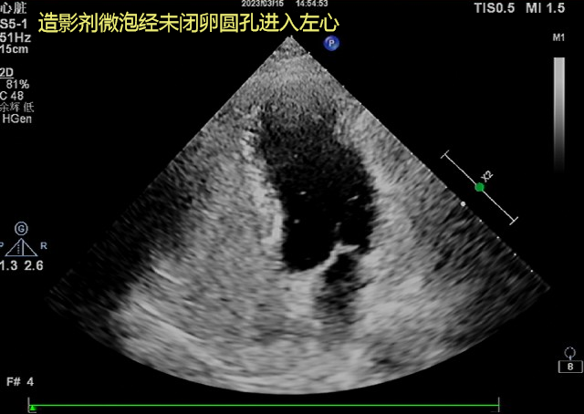 造影劑微泡經(jīng)未閉卵圓孔進入左心.png